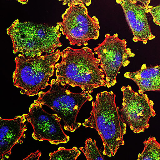 A new study says immune therapies  can be more effective in treating certain kinds of cancers, like Melanoma cells, seen here.
